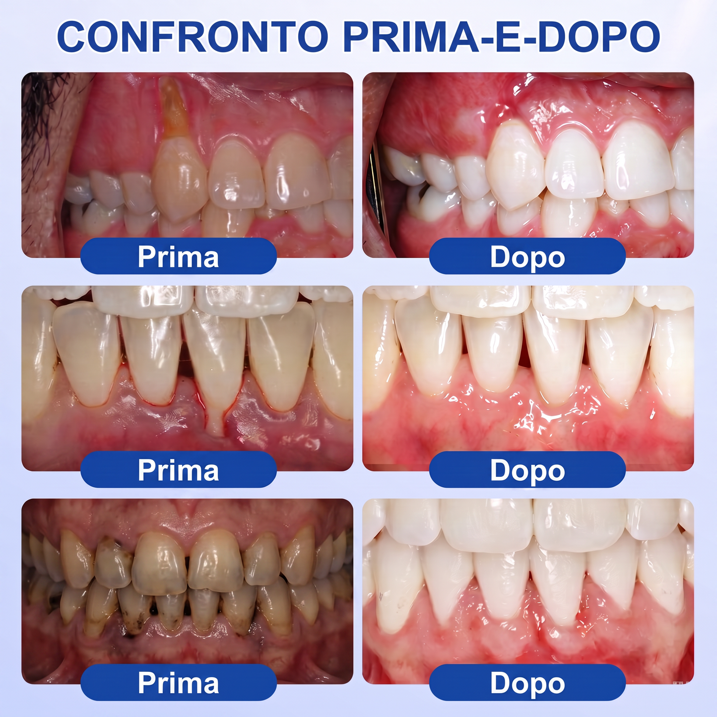 🇮🇹Glimmerly® 🦷GUMREVIVE GEL RIPARATORE PERIODONTALE🏆