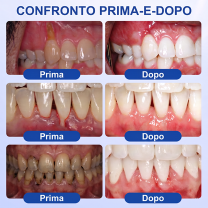 🇮🇹Glimmerly® 🦷GUMREVIVE GEL RIPARATORE PERIODONTALE🏆