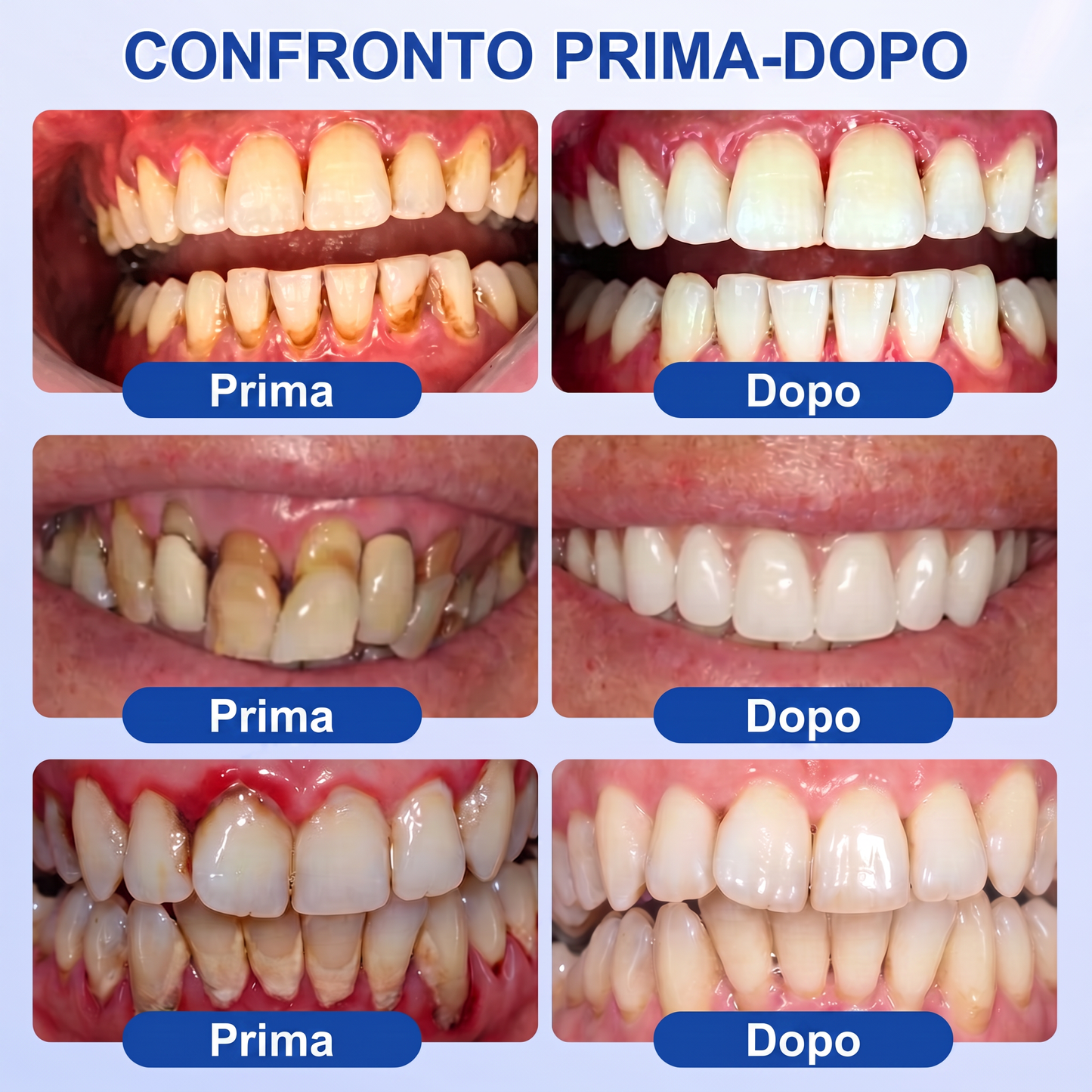 🇮🇹Glimmerly® 🦷GUMREVIVE GEL RIPARATORE PERIODONTALE🏆