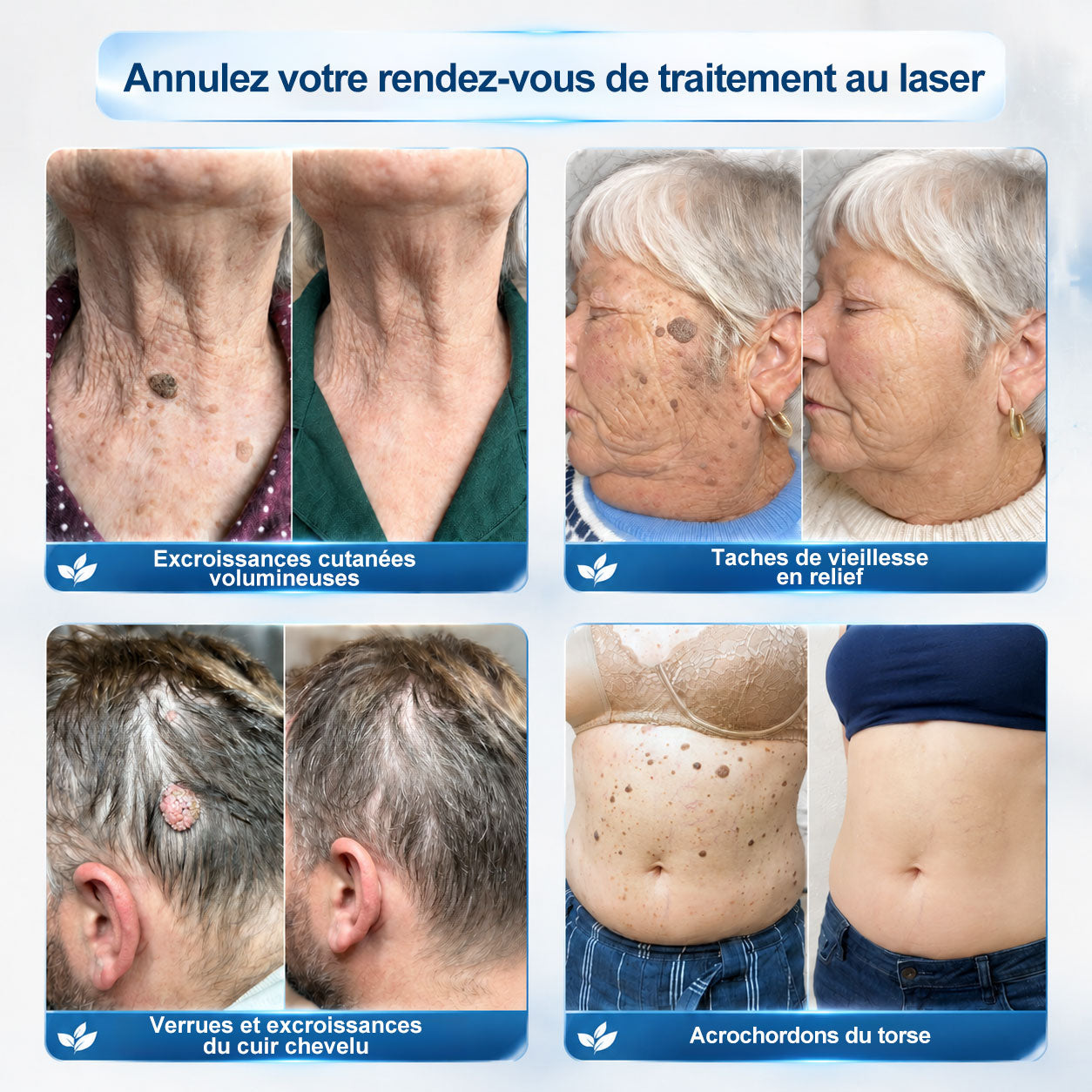 𝐏𝐢𝐜𝐝𝐨® 👨‍⚕️ 𝐒𝐨𝐥𝐮𝐭𝐢𝐨𝐧 𝐜𝐢𝐛𝐥é𝐞 𝟕 𝐣𝐨𝐮𝐫𝐬 𝐩𝐨𝐮𝐫   𝐚𝐜𝐫𝐨𝐜𝐡𝐨𝐫𝐝𝐨𝐧𝐬 𝐞𝐭 𝐢𝐦𝐩𝐞𝐫𝐟𝐞𝐜𝐭𝐢𝐨𝐧𝐬(Roll-on indolore et sans trace)🪉