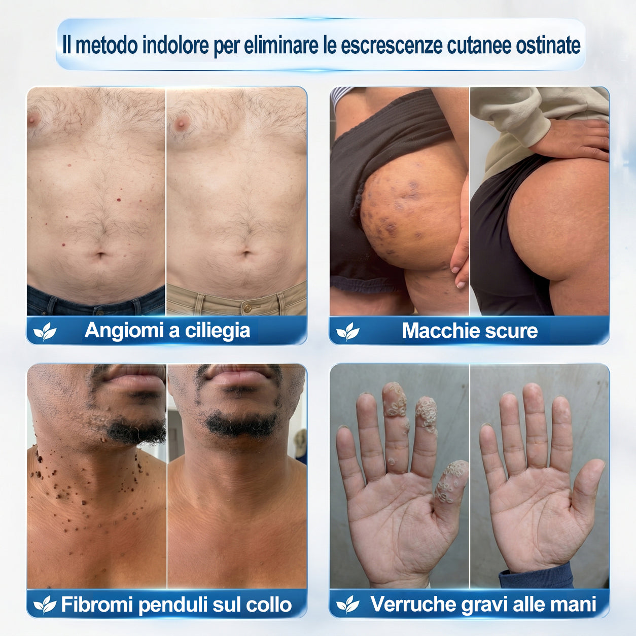 𝐏i𝐜𝐝o® 💡 Soluzione mirata di 7 giorni per la cura degli acrocordoni e delle imperfezioni cutanee (Applicazione indolore con roll-on, senza lasciare segni)