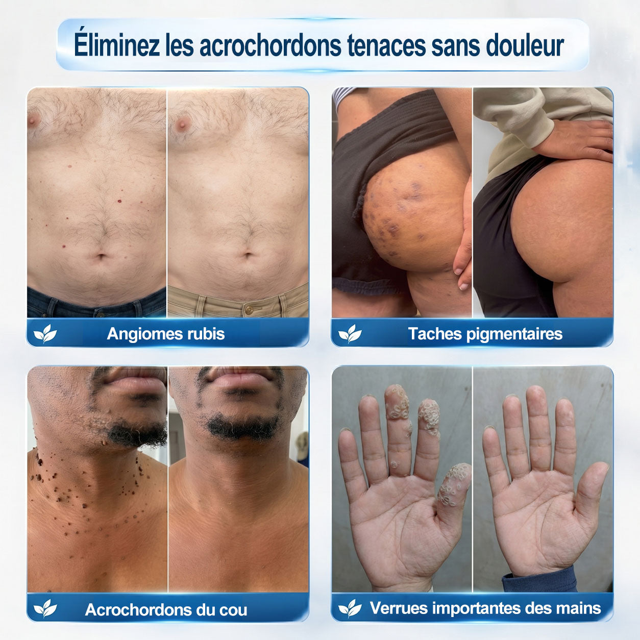 𝐏𝐢𝐜𝐝𝐨® 👨‍⚕️ 𝐒𝐨𝐥𝐮𝐭𝐢𝐨𝐧 𝐜𝐢𝐛𝐥é𝐞 𝟕 𝐣𝐨𝐮𝐫𝐬 𝐩𝐨𝐮𝐫   𝐚𝐜𝐫𝐨𝐜𝐡𝐨𝐫𝐝𝐨𝐧𝐬 𝐞𝐭 𝐢𝐦𝐩𝐞𝐫𝐟𝐞𝐜𝐭𝐢𝐨𝐧𝐬(Roll-on indolore et sans trace)🪉
