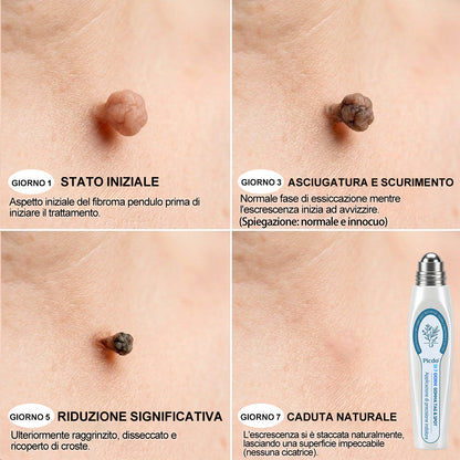 𝐏i𝐜𝐝o® 💡 Soluzione mirata di 7 giorni per la cura degli acrocordoni e delle imperfezioni cutanee (Applicazione indolore con roll-on, senza lasciare segni)