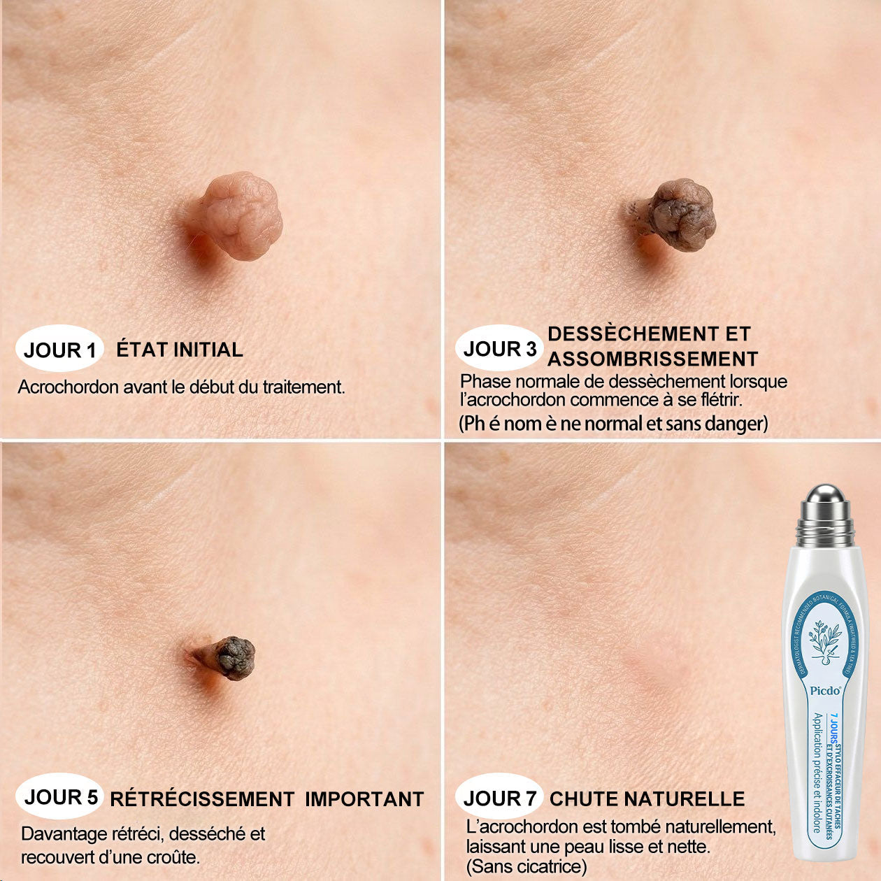 𝐏𝐢𝐜𝐝𝐨® 👨‍⚕️ 𝐒𝐨𝐥𝐮𝐭𝐢𝐨𝐧 𝐜𝐢𝐛𝐥é𝐞 𝟕 𝐣𝐨𝐮𝐫𝐬 𝐩𝐨𝐮𝐫   𝐚𝐜𝐫𝐨𝐜𝐡𝐨𝐫𝐝𝐨𝐧𝐬 𝐞𝐭 𝐢𝐦𝐩𝐞𝐫𝐟𝐞𝐜𝐭𝐢𝐨𝐧𝐬(Roll-on indolore et sans trace)🪉